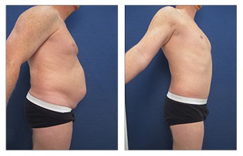 Tummy Tuck for Men  Torso Tuck Surgery