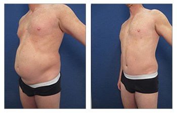 Tummy Tuck for Men  Cosmetic Plastic Surgery Institute