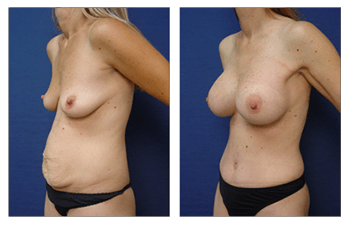 breast procedure pre-pregnancy Newport Beach