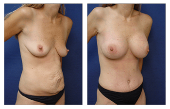 Best Tummy Tuck