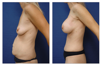 Breast aguementation San Diego