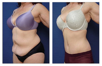 Tummy Tuck Alternative