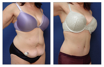 Tummy Tuck Alternative  Cosmetic Plastic Surgery Institute