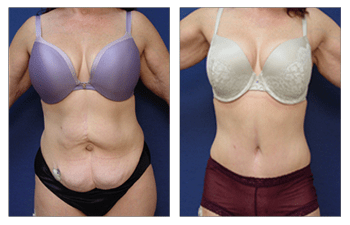 abdominal contouring Los Angeles