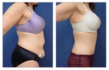 Tummy Tuck Alternative