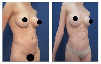 abdominal etching before and after