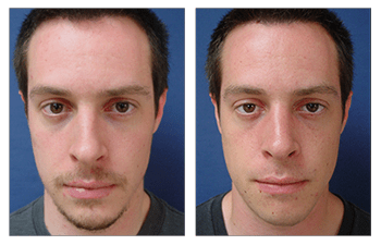 closed rhinoplasty incisions patient 5 before and after