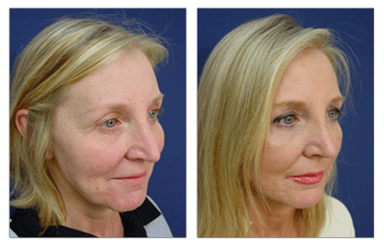 Closed Rhinoplasty Swelling Cosmetics Surgery Beverly Hills