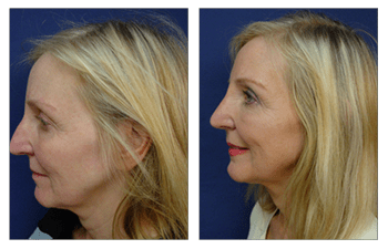 closed rhinoplasty swelling patient 6 left view