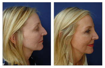 Closed Rhinoplasty Swelling Cosmetics Surgery Beverly Hills