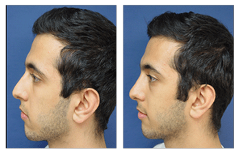 crooked nose causes patient 1 left view