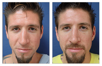 crooked nose surgery patient 3 before and after