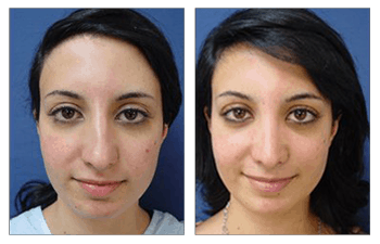 crooked nose bridge patient 4 before and after