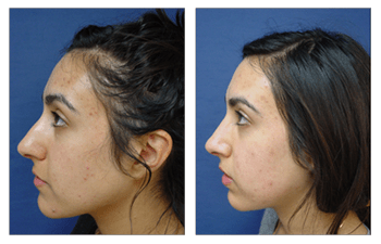 Crooked Nose Tip, Cosmetics Surgery