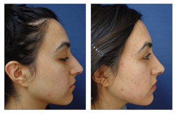 rhinoplasty surgery Dana Point