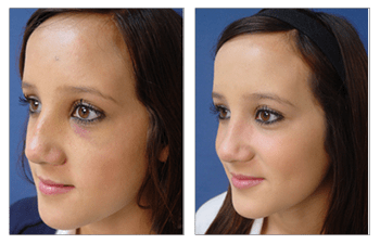 crooked nose rhinoplasty patient 7 front left view