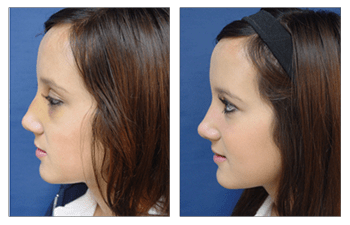 Crooked Nose After Rhinoplasty