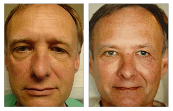 dermal fillers patient 1 before and after