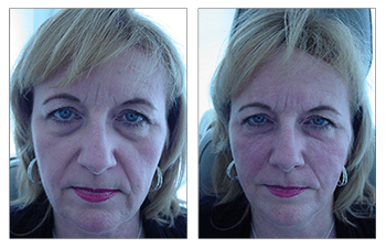 dermal fillers patient 2 before and after