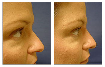 dermal fillers cost patient 3 right view