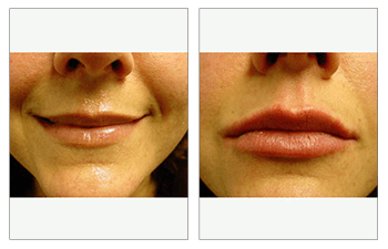 injectable cheek fillers patient 6 before and after