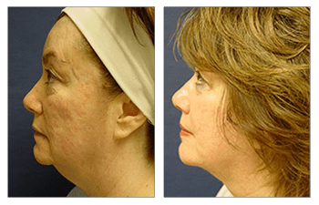 liposuction face patient 2 left view