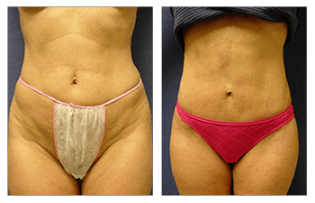 mini tummy tuck patient 2 before and after