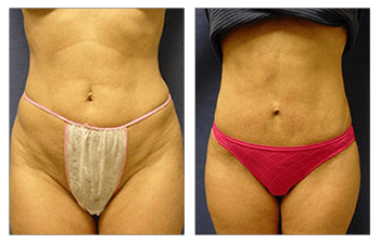 Mini Tuck And Tummy Tuck (abdominoplasty) Before & After Photos Patient 06