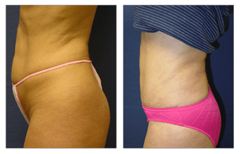 Laser Lipo/Mini Tummy Tuck Journey with Before & After Photos - Redhead Can  Decorate