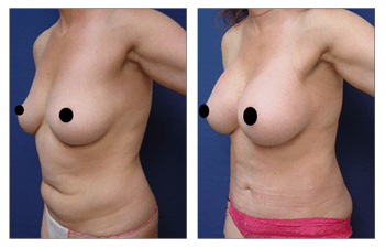 mini tummy tuck patient 27 front left view, Eliminating Upper Belly Stretch Marks