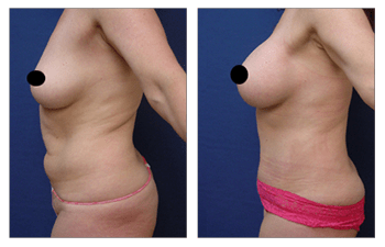 Full Tummy Tuck After C-Section 39-Year-Old Patient Left Profile