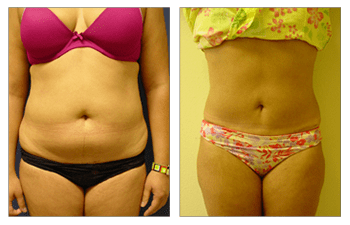 Mini Tummy Tuck Reviews  Cosmetic Plastic Surgery Institute