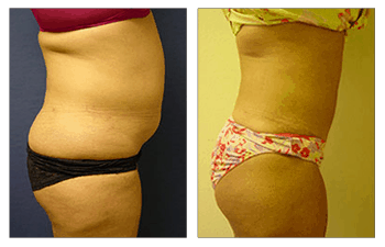 Liposuction and Mini Tummy Tuck