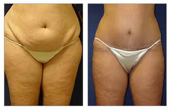 Mini Tummy Tuck