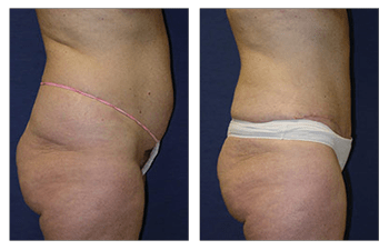 Tummy Tuck Scars Before & After, Patient 04