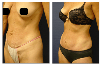 Mini Tummy Tuck Recovery  Cosmetic Plastic Surgery Institute