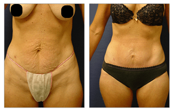 Liposuction / Mini Tummy Tuck, Otolaryngology & Facial Plastic Surgery  located in Baxter and Mendota Heights, MN