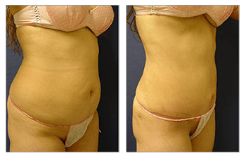 Mini TT without MR/mons lift, lipo to full abs, flanks, and bra roll. :  r/tummytuck_january2023