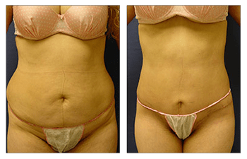 The Mini Tummy Tuck--A Small Procedure with Big Results