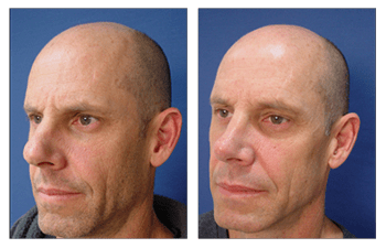 Secondary Rhinoplasty Recovery