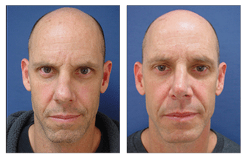 Secondary Rhinoplasty Recovery