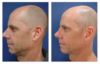 revision rhinoplasty patient 3 left view