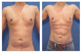 vaser lipo surgery before and after