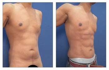 Vaser Lipo UK, Cosmetic Plastic Surgery Institute