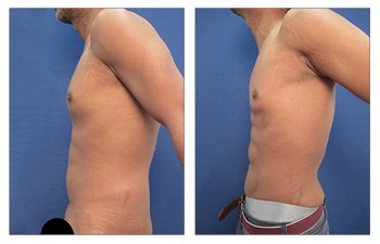 Liposuction of the flanks Beverly Hills - Smaller Waist- Flanks Lipo