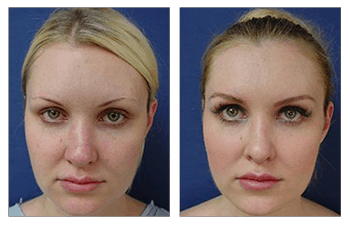 upturned nose caused by silicon implant - Revised rib carilage rhinoplasty  > Before & After Photo