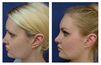 upturned nose caused by silicon implant - Revised rib carilage rhinoplasty  > Before & After Photo