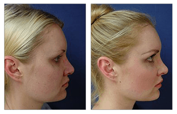 upturned nose caused by silicon implant - Revised rib carilage rhinoplasty  > Before & After Photo