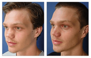 Revision Rhinoplasty Cost