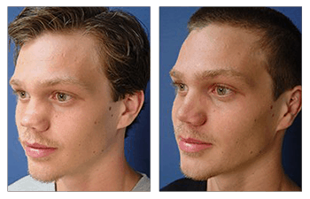 Revision Rhinoplasty Cost | Cosmetics Surgery | Beverly Hills.